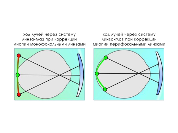 Перифокальные Линзы Для Очков Купить